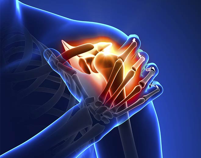 Inflamed shoulder joint with highlighted bones and ligaments