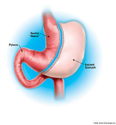sleeve-gastrectomy.tmb-small