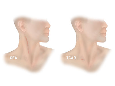 tcar-image-1-400-x-300